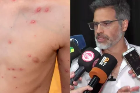 Confirman un brote de varicela en Entre Ríos: hay 700 casos y la mayoría son adolescentes
