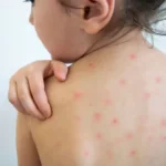 El CAPS Isidro Reggiardo abrirá este sábado para reforzar controles y vacunas en el marco de la alerta sanitaria