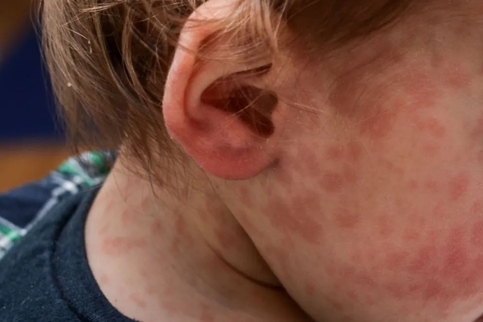 Ante la confirmación de un caso de sarampión, Salud convocó a comisión de vigilancia Interés General