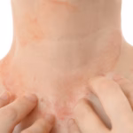 Una campaña de detección gratuita busca concientizar sobre la dermatitis atópica
